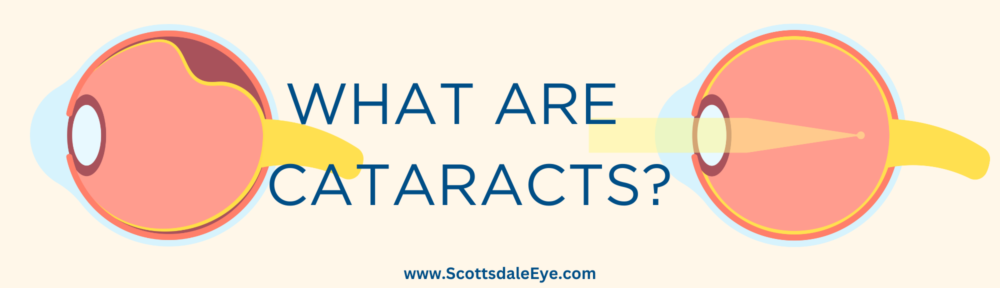 Understanding the Effects of Cataracts on Your Eyes